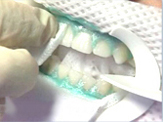 Perfect Smile ZOOM tooth whitening